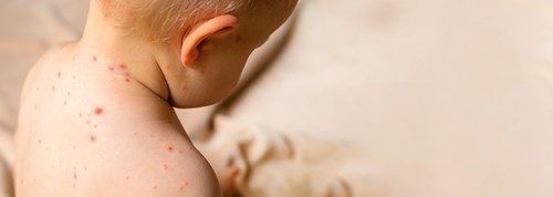 Skoldkopper – hvad er skoldkopper – ApoPro.dk